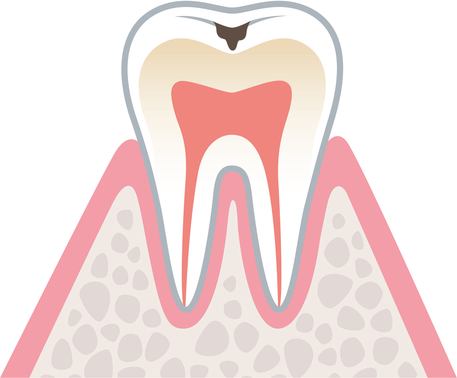 虫歯の進行１