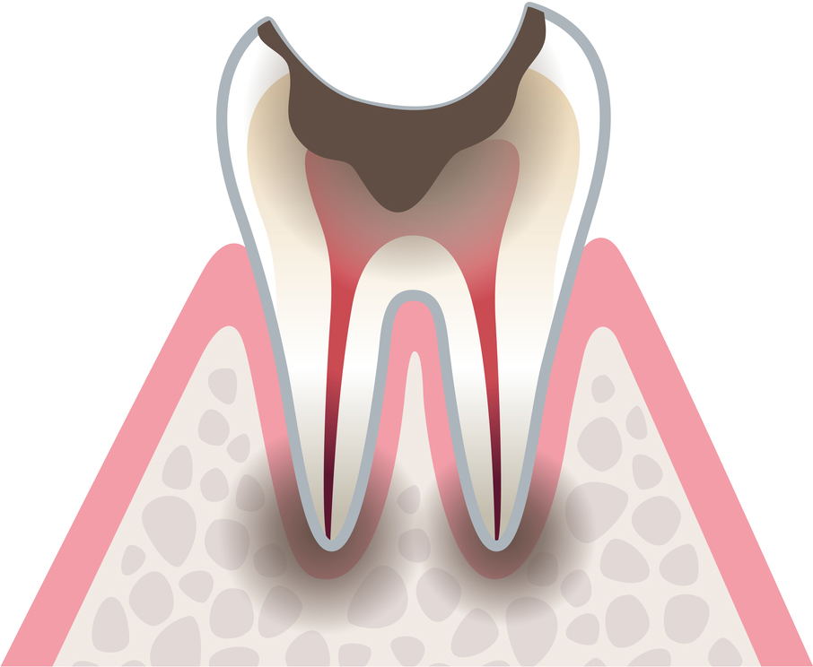 虫歯の進行４