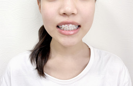 子供の歯列矯正はいつから始めるべき？